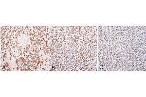 Immunohistochemistry with anti-matrix metalloproteinase 1 (MMP-1) primary antibody with positive reaction visible as brown staining. (MMP1 抗体  (C-Term))