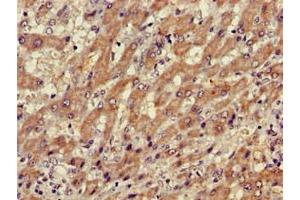 Immunohistochemistry of paraffin-embedded human liver cancer using ABIN7175883 at dilution of 1:100 (XBP1 抗体  (AA 1-167))