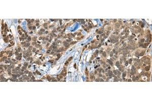 Immunohistochemistry of paraffin-embedded Human thyroid cancer tissue using CBFA2T3 Polyclonal Antibody at dilution of 1:45(x200)