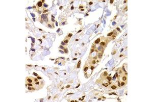 Immunohistochemistry of paraffin-embedded human breast cancer using HNRNPA1 Antibody (ABIN5975570) at dilution of 1/100 (40x lens). (HNRNPA1 抗体)