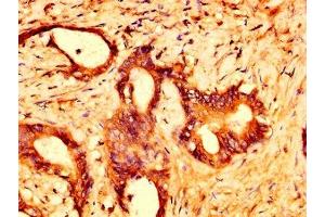 IHC image of ABIN7164465 diluted at 1:500 and staining in paraffin-embedded human colon cancer performed on a Leica BondTM system. (GPR158 抗体  (AA 882-1003))
