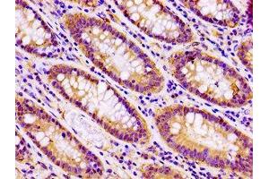 IHC image of ABIN7171142 diluted at 1:100 and staining in paraffin-embedded human colon cancer performed on a Leica BondTM system. (SNAP23 抗体  (AA 90-196))