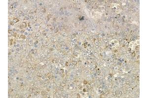 ABIN6259895 and ABIN6273991 at 1/100 staining human melanoma by IHC-P.