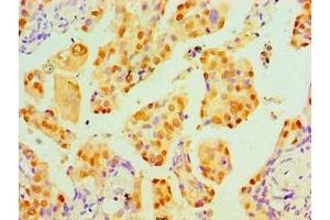 Immunohistochemistry (IHC) image for anti-Tumor Protein P53 (TP53) antibody (ABIN7172317)