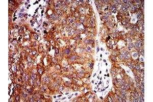 Immunohistochemical analysis of paraffin-embedded ovarian cancer tissues using UFD1L mouse mAb with DAB staining. (UFD1L 抗体  (AA 208-307))