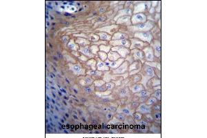CDCA8 Antibody (N-term) (ABIN656687 and ABIN2845924) immunohistochemistry analysis in formalin fixed and paraffin embedded human esophageal carcinoma followed by peroxidase conjugation of the secondary antibody and DAB staining. (CDCA8 抗体  (N-Term))