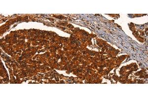 Immunohistochemistry of paraffin-embedded Human breast cancer using PRKD1 Polyclonal Antibody at dilution of 1:40 (PKC mu 抗体)