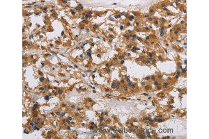 Immunohistochemistry of Human gastric cancer using IL17RB Polyclonal Antibody at dilution of 1:40 (IL17 Receptor B 抗体)