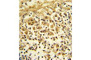 Formalin-fixed and paraffin-embedded human lymph reacted with ENO1 Antibody (Center), which was peroxidase-conjugated to the secondary antibody, followed by DAB staining. (ENO1 抗体  (AA 178-205))