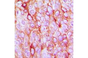 Immunohistochemical analysis of TGF alpha staining in human breast cancer formalin fixed paraffin embedded tissue section.