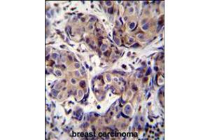MAGEA3 Antibody immunohistochemistry analysis in formalin fixed and paraffin embedded human breast carcinoma followed by peroxidase conjugation of the secondary antibody and DAB staining. (MAGEA3 抗体  (C-Term))