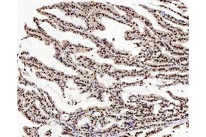 Immunohistochemistry analysis of paraffin-embedded human stomach cancer using c-Fos Polyclonal Antibody at dilution of 1:200. (c-FOS 抗体)