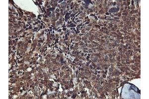 Immunohistochemical staining of paraffin-embedded Adenocarcinoma of Human breast tissue using anti-AKT1 mouse monoclonal antibody. (AKT1 抗体)