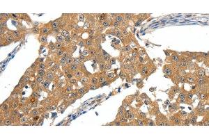Immunohistochemistry of paraffin-embedded Human breast cancer tissue using SCN5A Polyclonal Antibody at dilution 1:30 (SCN5A 抗体)