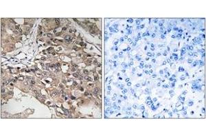Immunohistochemistry analysis of paraffin-embedded human breast carcinoma tissue, using MAP3K7 (Ab-187) Antibody. (MAP3K7 抗体  (AA 161-210))