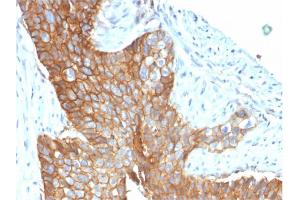 Formalin-fixed, paraffin-embedded human Cervical Carcinoma stained with CD9 Mouse Monoclonal Antibody (CD9/1619).