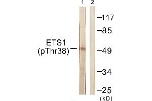 Immunohistochemistry analysis of paraffin-embedded human breast carcinoma tissue using ETS1 (Phospho-Thr38) antibody. (ETS1 抗体  (pThr38))