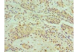 Immunohistochemistry of paraffin-embedded human breast cancer using ABIN7155132 at dilution of 1:100 (HNRNPM 抗体  (AA 491-730))