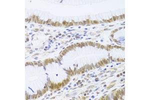 Immunohistochemistry of paraffin-embedded human gastric cancer using MCM4 Antibody (ABIN5971548) at dilution of 1/100 (40x lens). (MCM4 抗体)