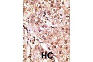 Formalin-fixed and paraffin-embedded human hepatocellular carcinoma tissue reacted with IL29 polyclonal antibody  , which was peroxidase-conjugated to the secondary antibody, followed by DAB staining. (IL29 抗体  (Internal Region))