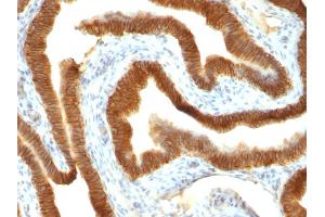 Formalin-fixed, paraffin-embedded human Colon Carcinoma stained with Ep-CAM Mouse Monoclonal Antibody (VU-1D9). (EpCAM 抗体)
