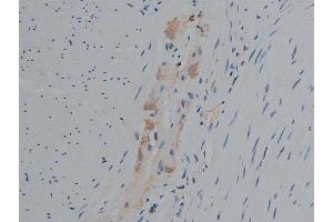 ABIN6267420 at 1/50 staining human colon carcinoma tissue sections by IHC-P.
