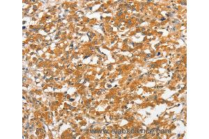 Immunohistochemistry of Human gastric cancer using ANKMY2 Polyclonal Antibody at dilution of 1:30 (ANKMY2 抗体)