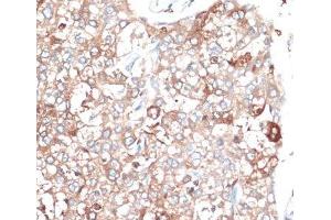 Immunohistochemistry of paraffin-embedded Human liver cancer using SLAMF7 Polyclonal Antibody at dilution of 1:100 (40x lens). (SLAMF7 抗体)