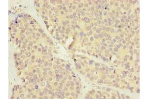 Immunohistochemistry of paraffin-embedded human gastric cancer using ABIN7175622 at dilution of 1:100 (LRRC8E 抗体  (AA 353-630))