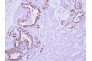 IHC-P Image Immunohistochemical analysis of paraffin-embedded human breast cancer, using MCL1, antibody at 1:250 dilution. (MCL-1 抗体  (Center))