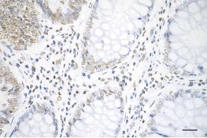 Immunohistochemistry was performed on paraffin-embedded human sigmoid colon carcinoma using histone H3 (acetyl K19) antibody (ABIN7798970), 1:200). (Recombinant Histone 3 抗体  (H3K18ac))