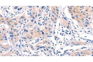 Immunohistochemistry of paraffin-embedded Human lung cancer tissue using AFDN Polyclonal Antibody at dilution 1:40 (Afadin 抗体)