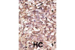 Formalin-fixed and paraffin-embedded human hepatocellular carcinoma tissue reacted with DKK4 polyclonal antibody  , which was peroxidase-conjugated to the secondary antibody, followed by DAB staining. (DKK4 抗体  (C-Term))