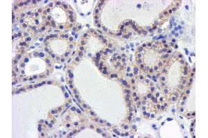 Immunohistochemical staining of paraffin-embedded Carcinoma of Human thyroid tissue using anti-GSTO2 mouse monoclonal antibody. (GSTO2 抗体)