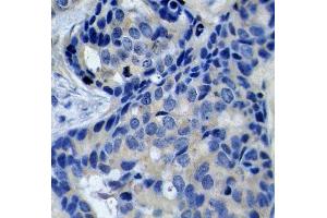 Immunohistochemistry of paraffin-embedded human breast carcinoma using Phospho-PTK2B-Y402 antibody (ABIN2987623). (PTK2B 抗体  (pTyr402))