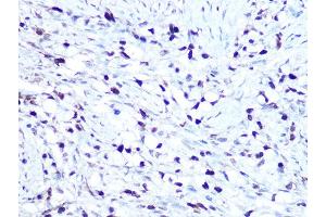 Immunohistochemistry of paraffin-embedded human oophoroma using HMG Rabbit mAb (ABIN7267646) at dilution of 1:100 (40x lens). (HMGA1 抗体)
