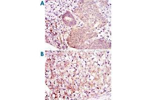 Immunohistochemical analysis of paraffin-embedded human ovarian cancer (A) and kidney cancer (B) using MAP2K6 monoclonal antibody, clone 3H12B9  with DAB staining.