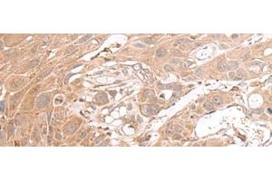 Immunohistochemistry of paraffin-embedded Human esophagus cancer tissue using CHST4 Polyclonal Antibody at dilution of 1:35(x200) (CHST4 抗体)