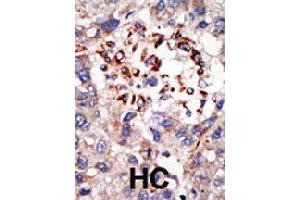 Formalin-fixed and paraffin-embedded human hepatocellular carcinoma tissue reacted with CBX8 polyclonal antibody  , which was peroxidase-conjugated to the secondary antibody, followed by DAB staining . (CBX8 抗体  (C-Term))