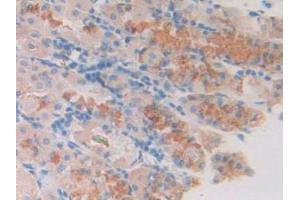 IHC-P analysis of Human Stomach Cancer Tissue, with DAB staining. (SLIT1 抗体  (AA 647-835))