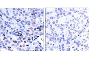 Immunohistochemistry analysis of paraffin-embedded human breast carcinoma tissue, using NF-kappaB p105/p50 (Ab-337) Antibody. (NFKB1 抗体  (AA 304-353))