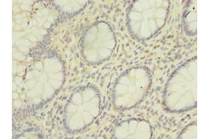 Immunohistochemistry of paraffin-embedded human colon cancer using ABIN7155121 at dilution of 1:100 (HNRNPL 抗体  (AA 89-335))