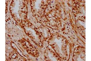 IHC image of ABIN7155735 diluted at 1:600 and staining in paraffin-embedded human prostate cancer performed on a Leica BondTM system. (HOXB3 抗体  (AA 315-423))