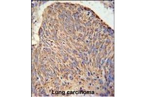 C Antibody (Center) (ABIN650934 and ABIN2840000) IHC analysis in formalin fixed and paraffin embedded human lung carcinoma followed by peroxidase conjugation of the secondary antibody and DAB staining. (CCDC130 抗体  (AA 173-200))