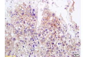 Formalin-fixed and paraffin embedded human lung carcinoma labeled with Anti-MICB Polyclonal Antibody, Unconjugated (ABIN1385296) at 1:200 followed by conjugation to the secondary antibody and DAB staining.