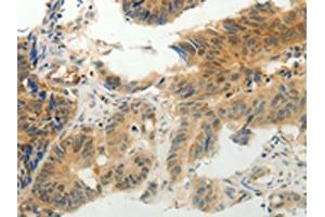 The image on the left is immunohistochemistry of paraffin-embedded Human colon cancer tissue using ABIN7190314(CMTM7 Antibody) at dilution 1/30, on the right is treated with synthetic peptide. (CMTM7 抗体)