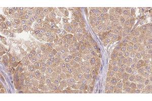 ABIN6277619 at 1/100 staining Human Melanoma tissue by IHC-P. (IL-27 抗体  (Internal Region))