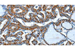 Immunohistochemistry of paraffin-embedded Human thyroid cancer using ALDH6A1 Polyclonal Antibody at dilution of 1:45 (ALDH6A1 抗体)