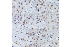 Immunohistochemistry of paraffin-embedded human esophageal cancer using MRE11 Rabbit pAb (ABIN3016249, ABIN3016250, ABIN3016251 and ABIN6219660) at dilution of 1:50 (40x lens). (Mre11 抗体  (AA 1-205))
