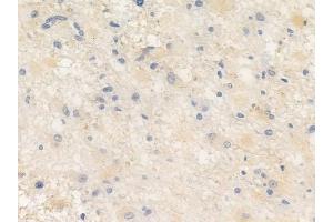 ABIN6256580 and ABIN6267383 at 1/100 staining human astrocytoma by IHC-P.